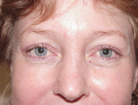 Eyelid Lift in San Francisco Patient After 2