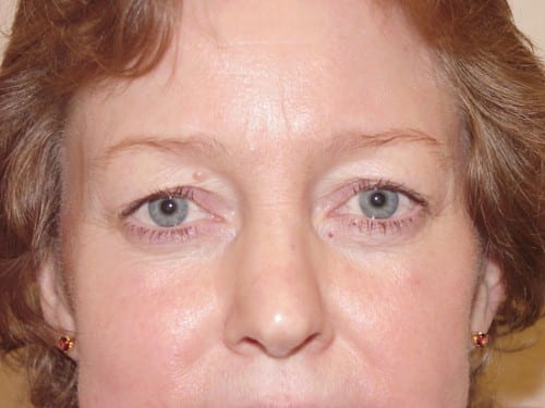 Blepharoplasty 02 Patient Before