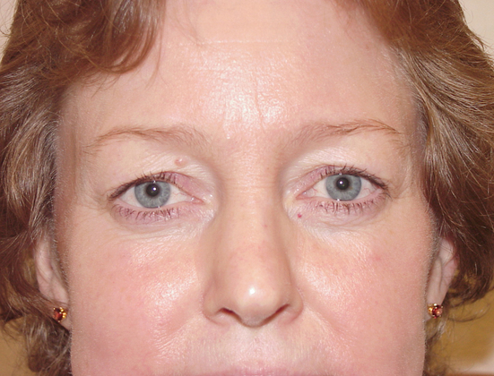 Eyelid Lift in San Francisco Patient Before 1