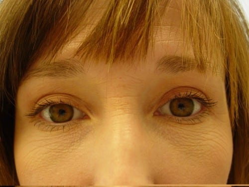 Blepharoplasty 03 Patient After