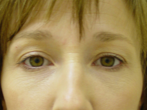 Eyelid Lift in San Francisco Patient Before 3