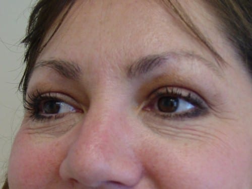 Blepharoplasty 04 Patient After