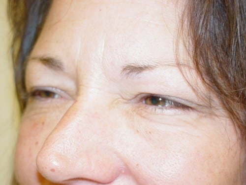 Blepharoplasty 04 Patient Before