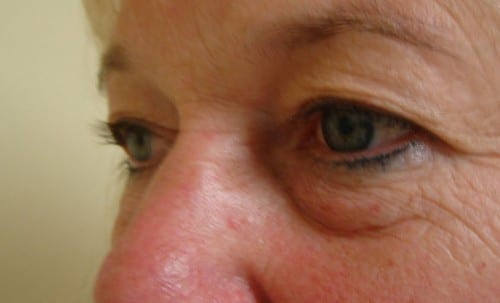 Blepharoplasty 05 Patient Before