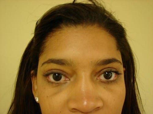 Blepharoplasty 06 Patient After