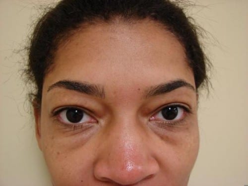 Blepharoplasty 06 Patient Before