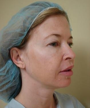 Blepharoplasty 07 Patient Before