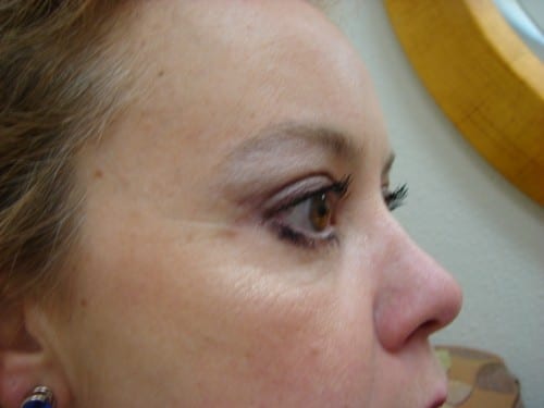 Blepharoplasty 08 Patient After