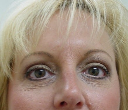 Blepharoplasty 09 Patient After