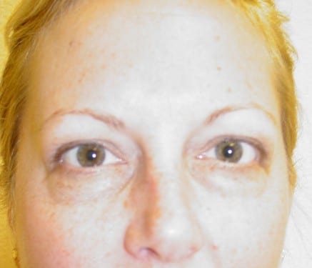 Blepharoplasty 09 Patient Before