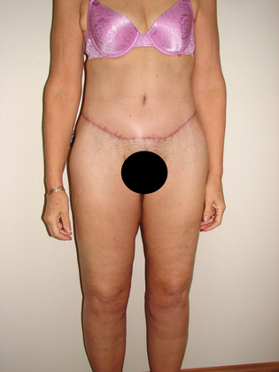 Body Contouring 02 Patient After