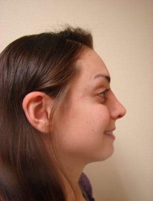 Facial Implants 01 Patient After