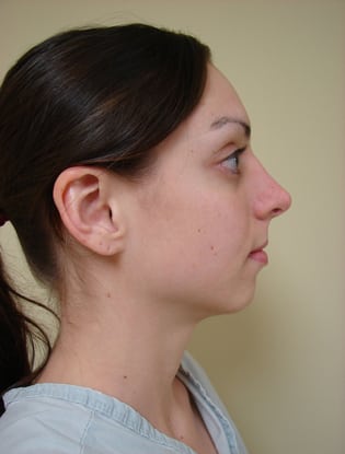 Facial Implants 01 Patient Before