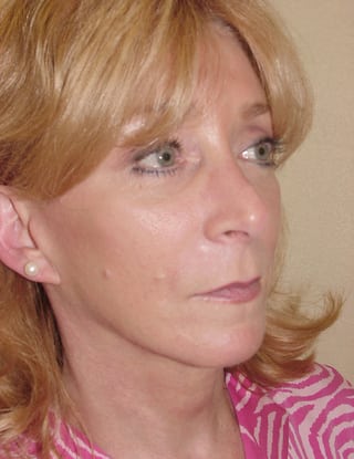 Facial Implants 03 Patient Before