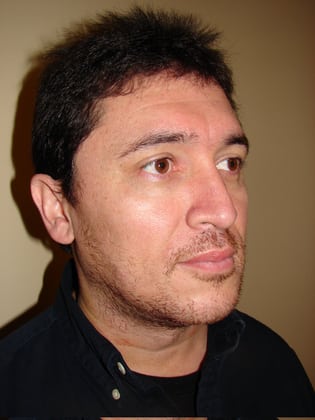Facial Implants 04 Patient After