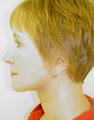 Facelift 10 Patient After