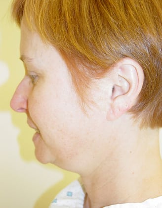 Facelift 10 Patient Before