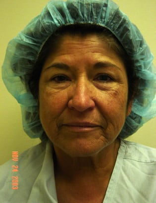 Facelift 12 Patient Before