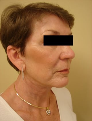 Facelift 02 Patient After