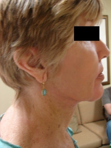 Facelift 06 Patient After