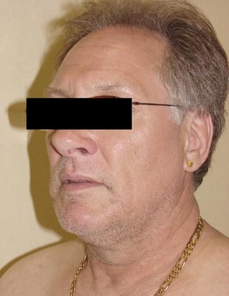Facelift 07 Patient Before