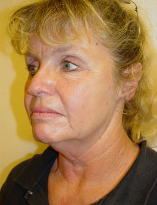 Facelift 11 Patient Before