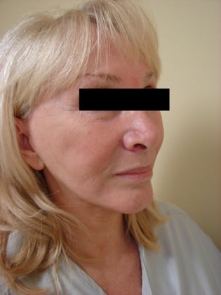 Facelift 01 Patient Before