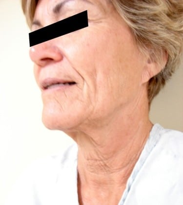 Facelift 05 Patient Before