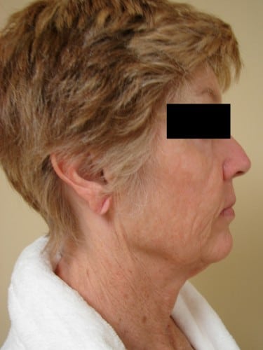 Facelift 06 Patient Before