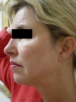 Facelift 08 Patient Before