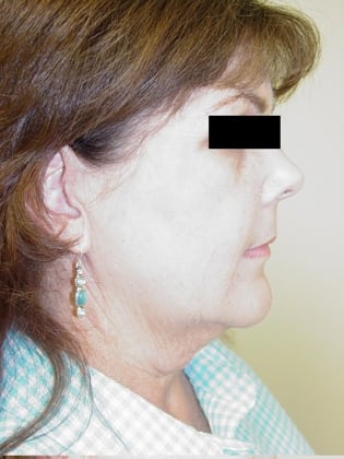 Facelift 09 Patient Before