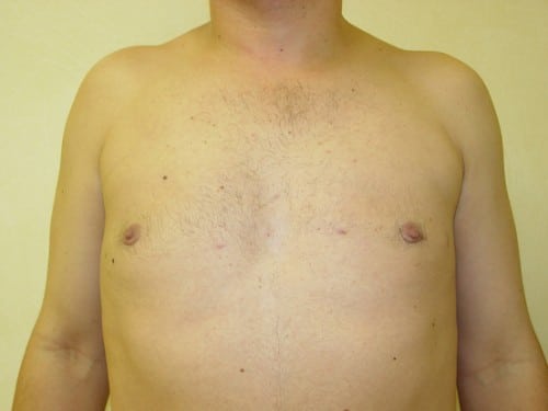 Gynecomastia 01 Patient After