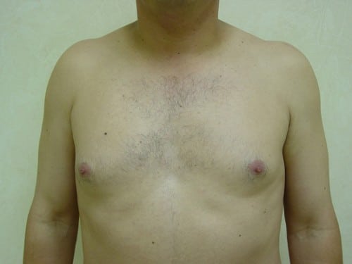 Gynecomastia 01 Patient Before