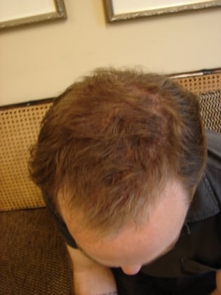 Hair Transplants 01 Patient After