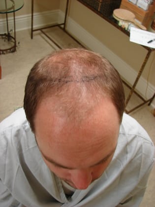 Hair Transplants 01 Patient Before