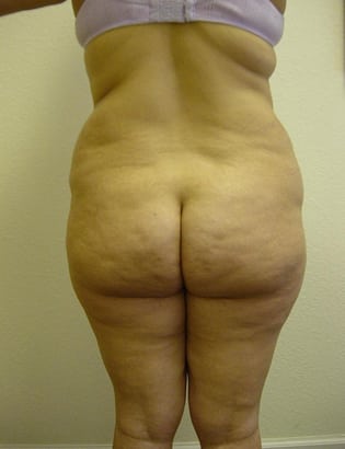 Liposuction 01 Patient Before