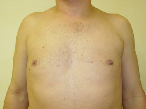 Liposuction 04 Patient After