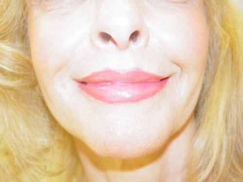 Lip Augmentation 02 Patient After