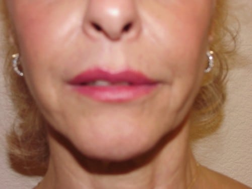 Lip Augmentation 02 Patient Before