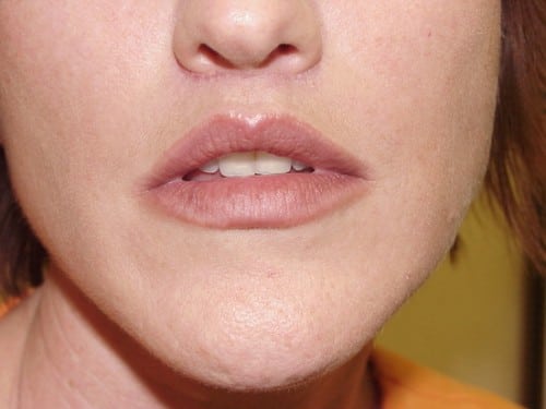 Lip Augmentation 03 Patient After