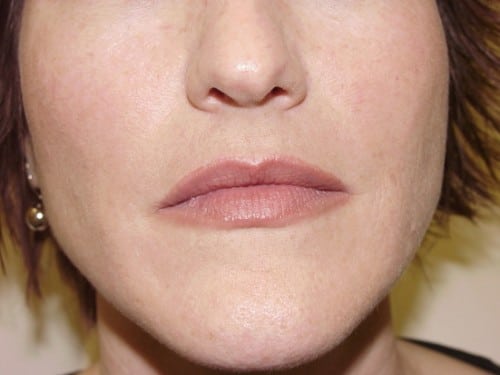 Lip Augmentation 03 Patient Before