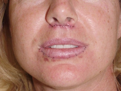 Lip Augmentation 05 Patient After