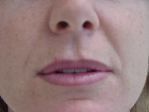 Lip Augmentation 05 Patient Before