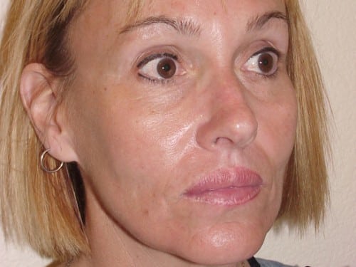 Lip Augmentation 06 Patient After