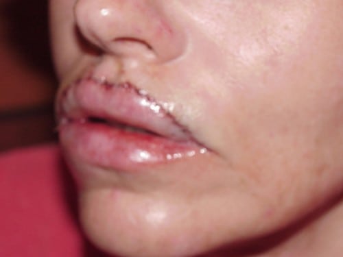 Lip Augmentation 06 Patient Before