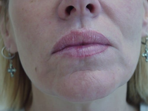 Lip Augmentation 07 Patient After