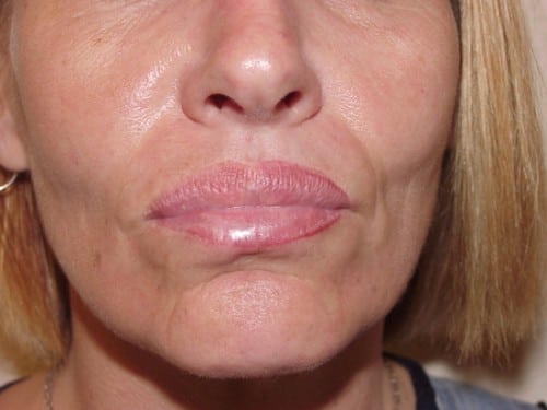 Lip Augmentation 07 Patient Before