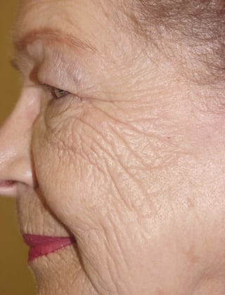 Laser Resurfacing 02 Patient Before