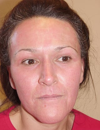 Laser Resurfacing 04 Patient After