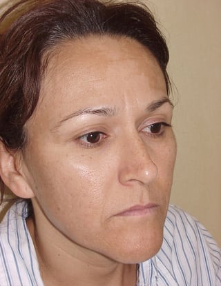 Laser Resurfacing 04 Patient Before